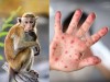Bài tuyên truyền phòng bệnh đậu mùa khỉ